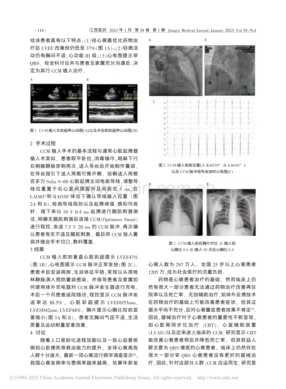 江西省首例心脏收缩力调节器植入病例报道_熊琴梅.pdf_第2页