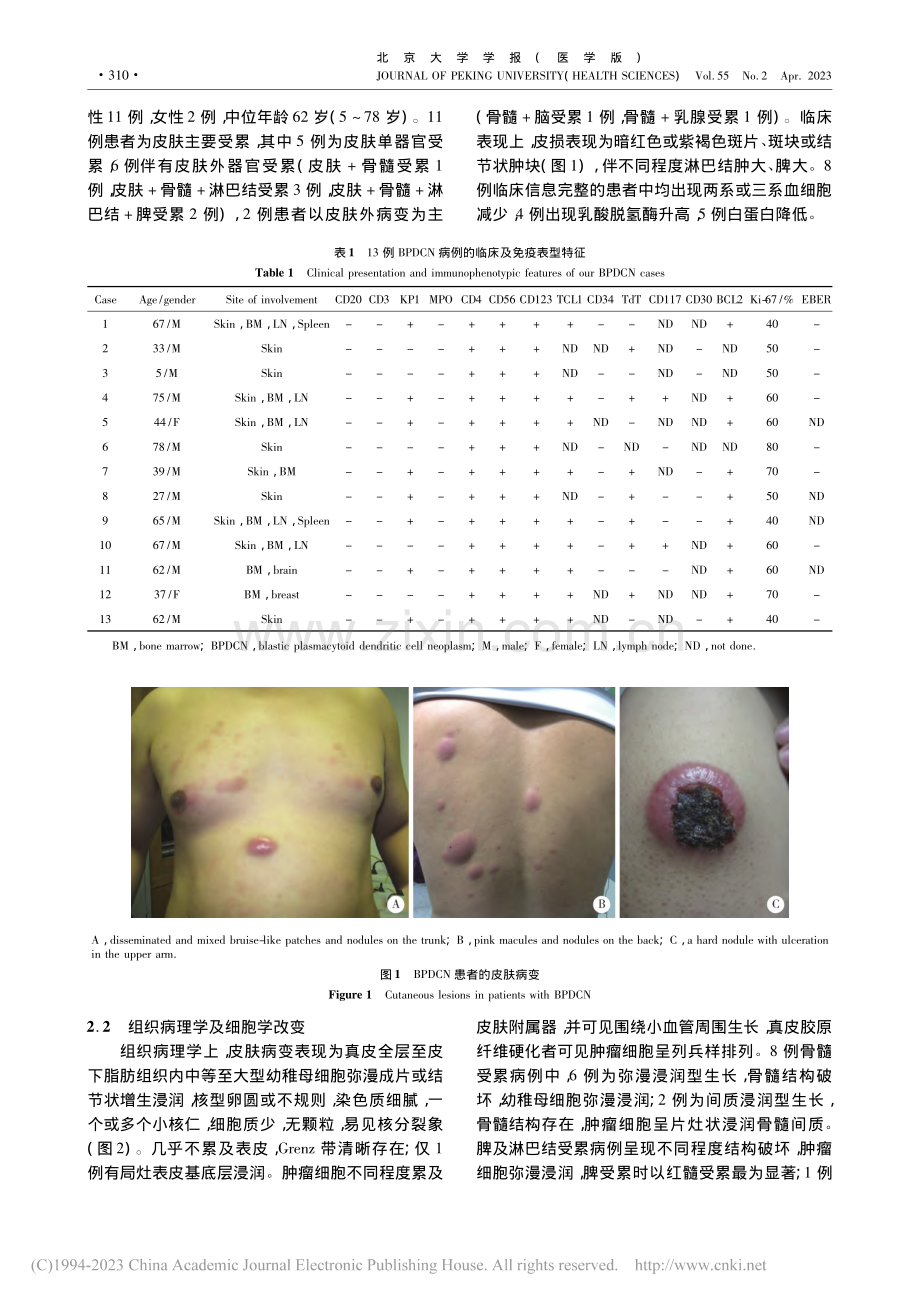 母细胞性浆样树突细胞肿瘤13例临床病理学特征_农琳.pdf_第3页