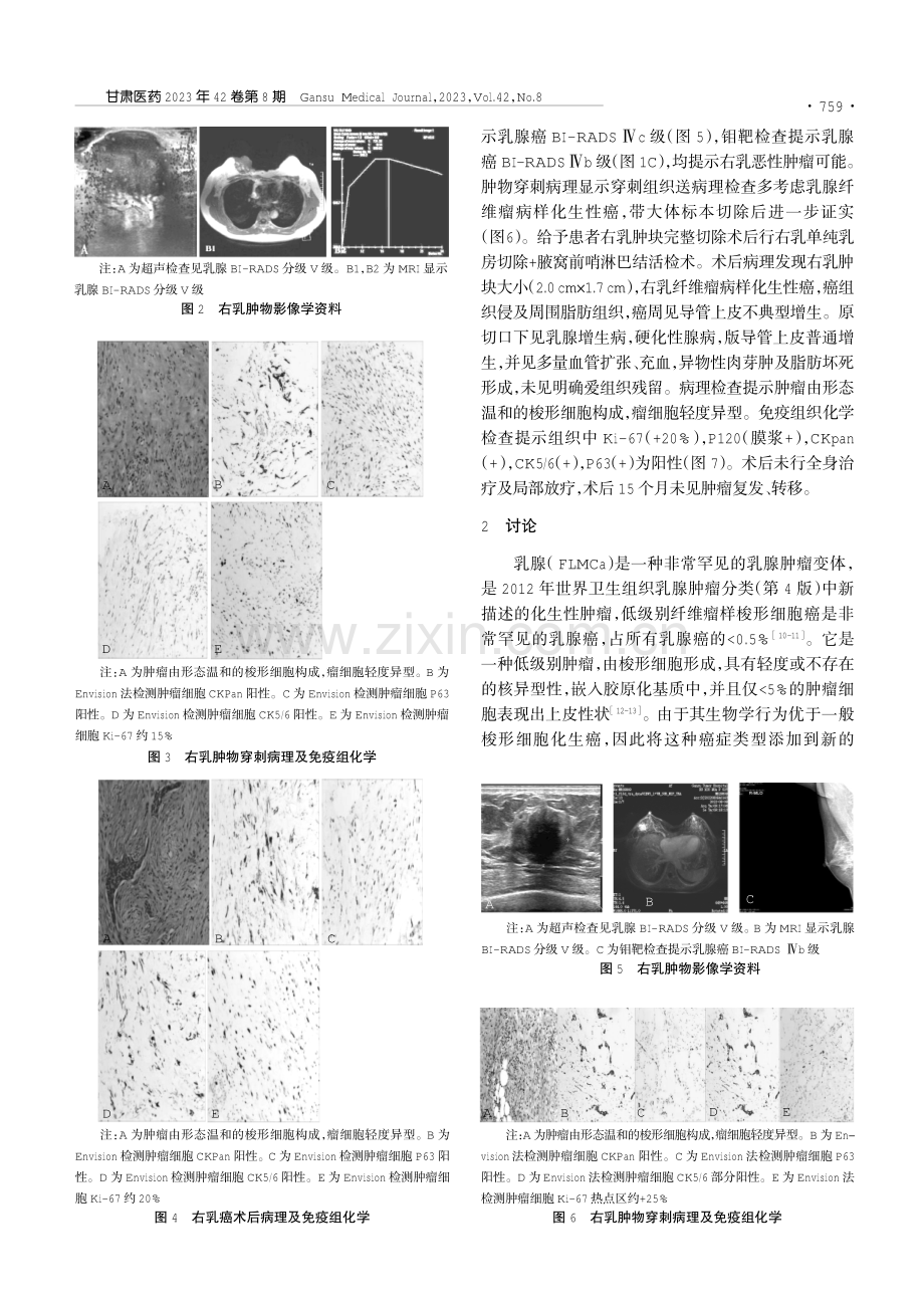 乳腺纤维瘤病样化生性癌2例临床病理报告.pdf_第2页