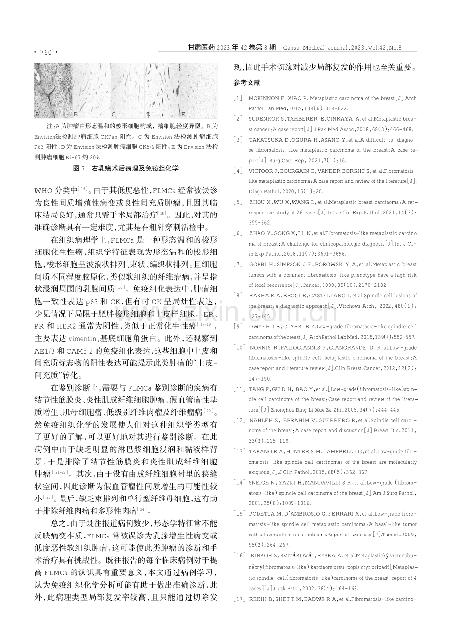 乳腺纤维瘤病样化生性癌2例临床病理报告.pdf_第3页