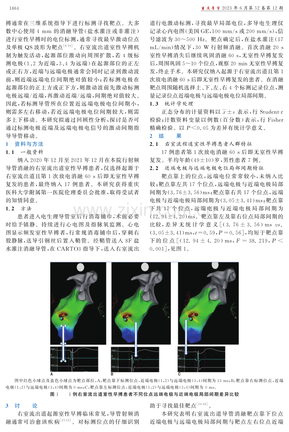 消融标测导管远端与近端电极电位间期对室性早搏消融的作用.pdf_第2页