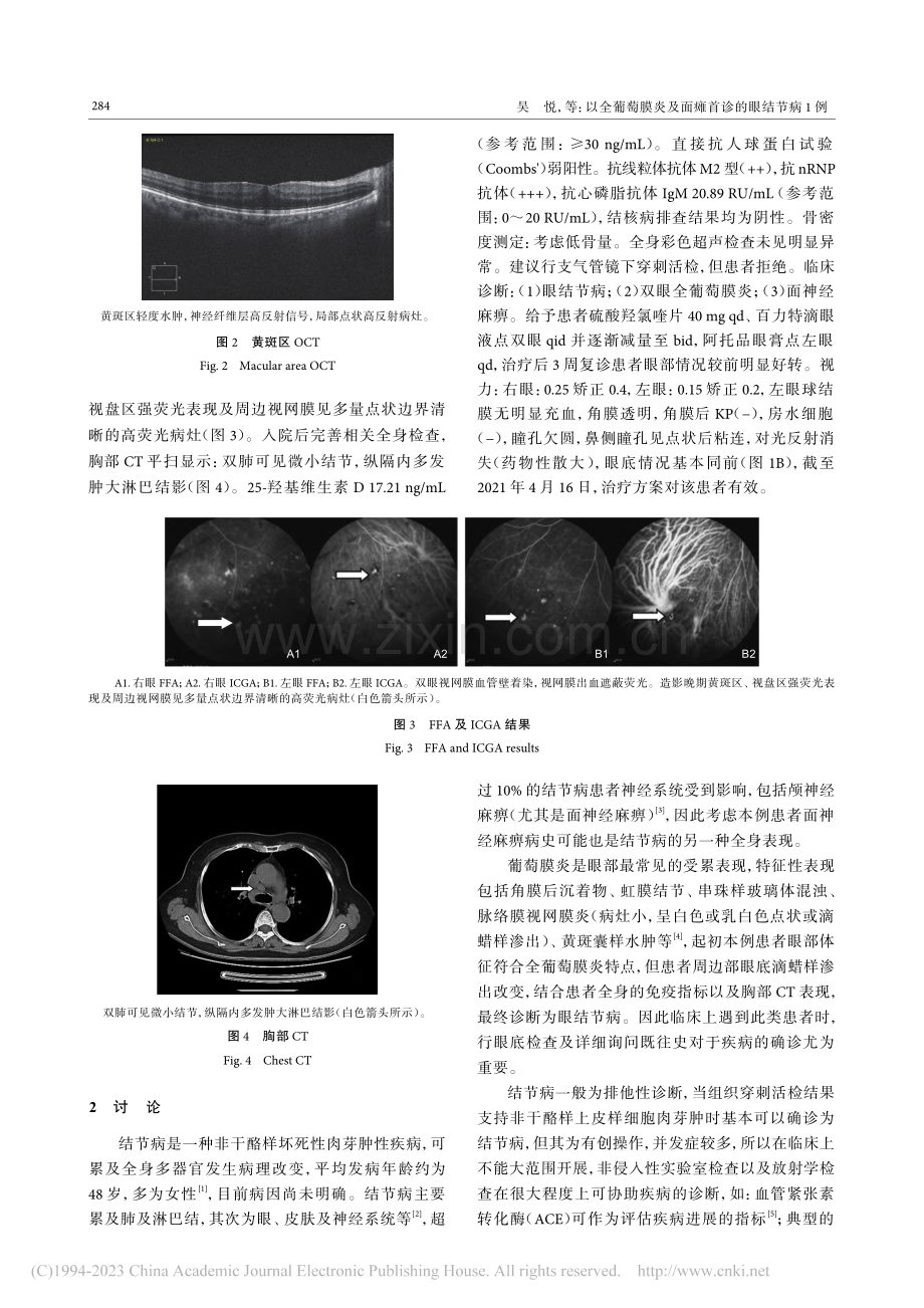 以全葡萄膜炎及面瘫首诊的眼结节病1例_吴悦.pdf_第2页