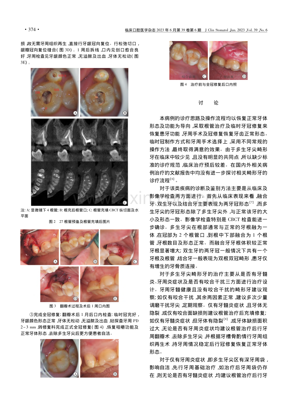 一例罕见上颌第二磨牙颊侧多...尖伴牙隐裂的多学科联合治疗_向舒畅.pdf_第2页