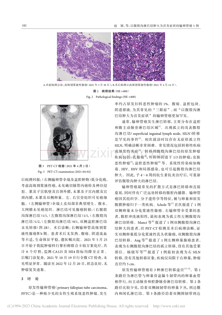 以腹股沟淋巴结肿大为首发症状的输卵管癌1例_赵颖.pdf_第2页