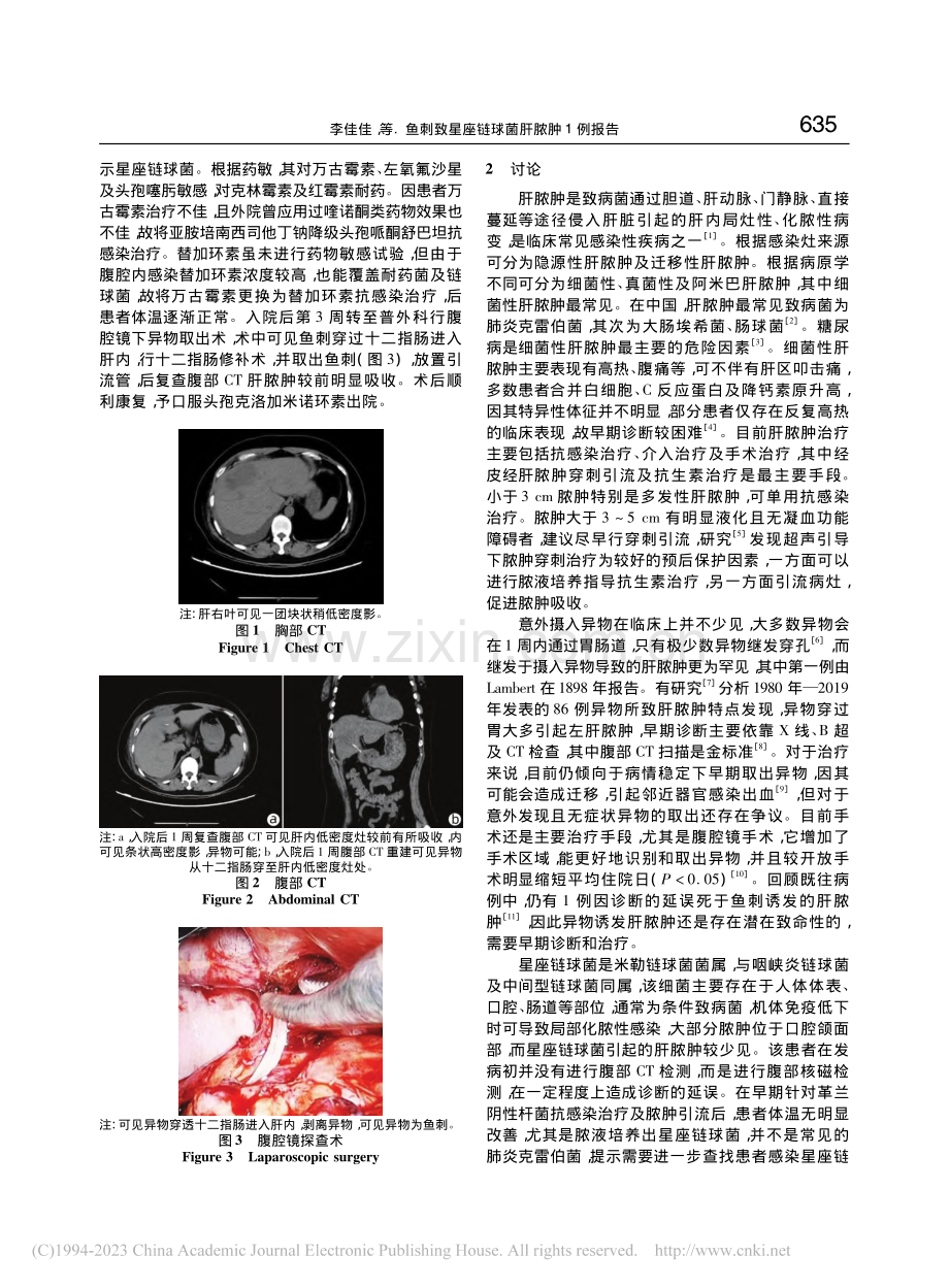 鱼刺致星座链球菌肝脓肿1例报告_李佳佳.pdf_第2页