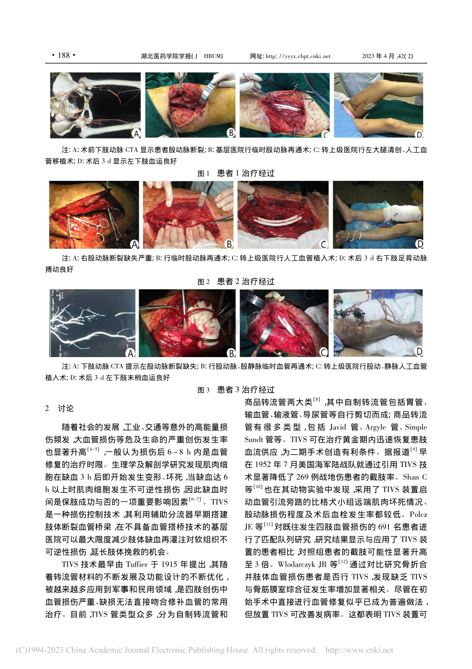 自制血管转流管在基层医疗保肢开放性股动脉断裂中的应用_李鹏鹏.pdf_第2页