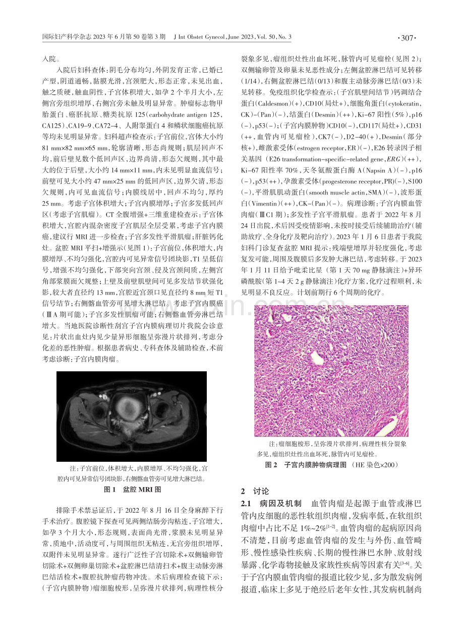 子宫内膜血管肉瘤一例并文献复习.pdf_第2页