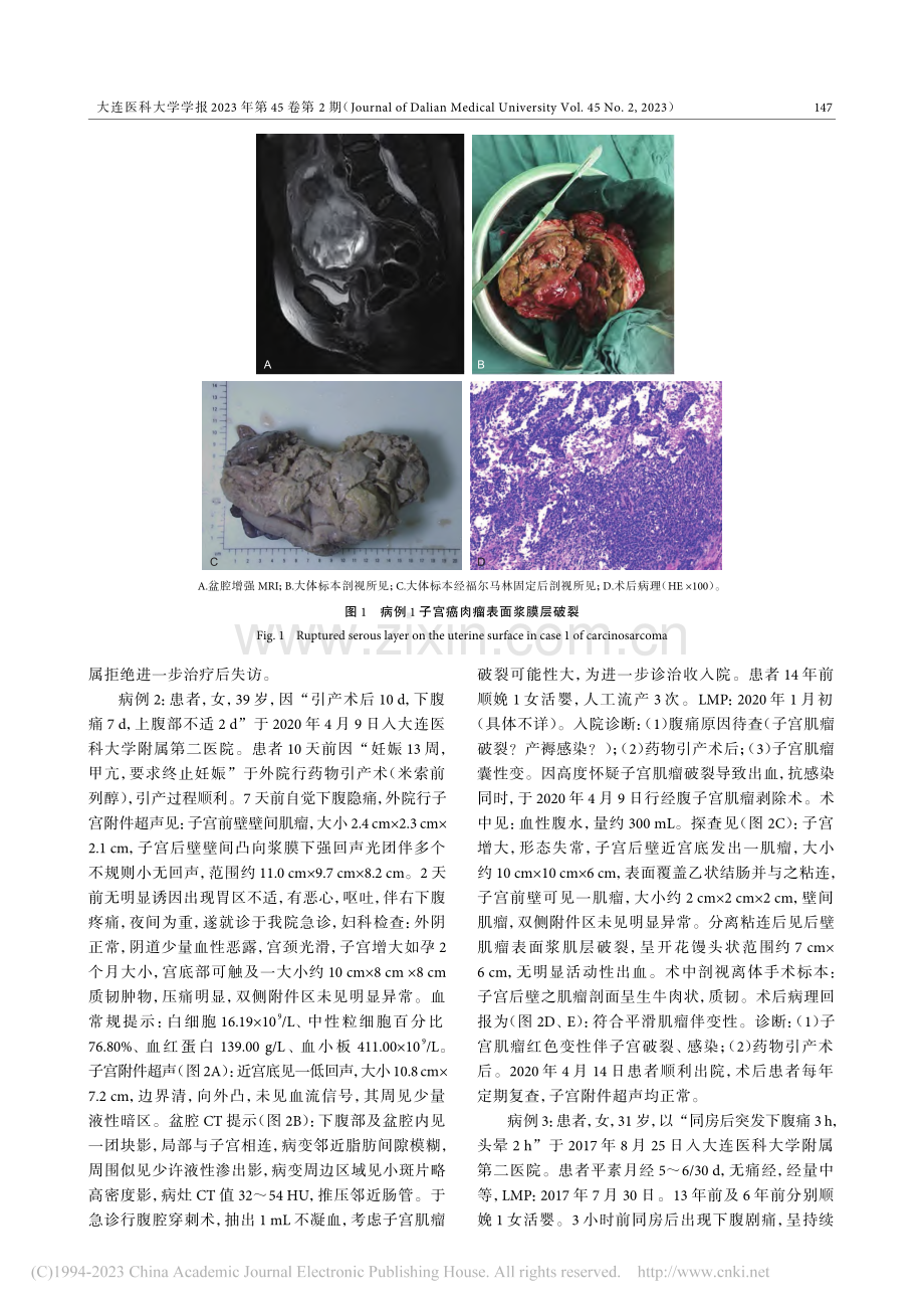 子宫肿瘤表面浆膜层破裂3例临床分析_孙海燕.pdf_第3页