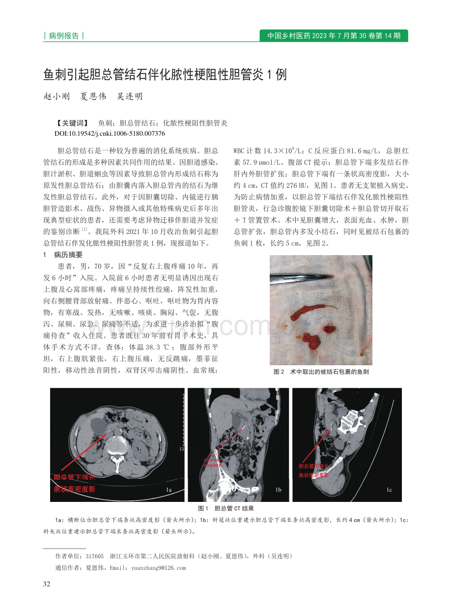 鱼刺引起胆总管结石伴化脓性梗阻性胆管炎1例_赵小刚.pdf_第1页