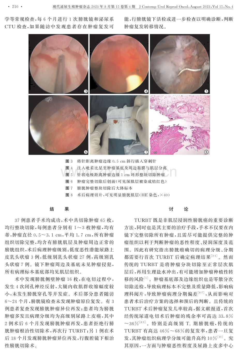 吡柔比星膀胱黏膜下注射配合等离子针状电极行经尿道膀胱肿瘤整块切除术的临床研究.pdf_第3页