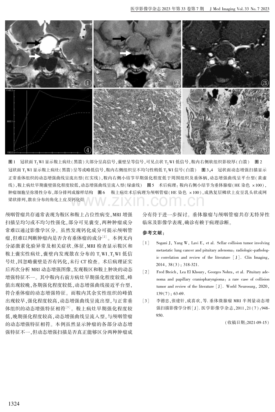 鞍区碰撞瘤1例.pdf_第2页