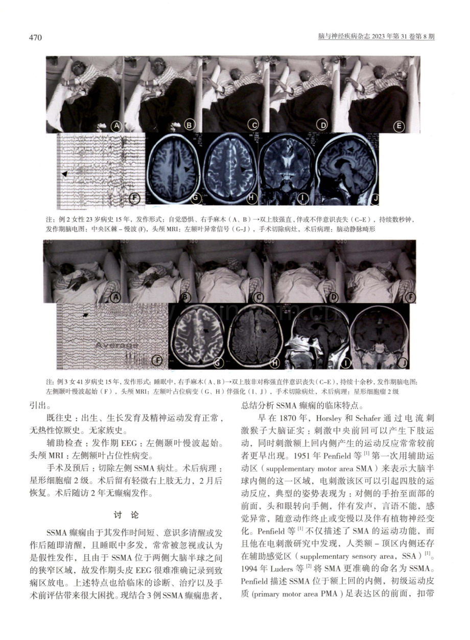 辅助感觉运动区癫痫的临床分析.pdf_第3页