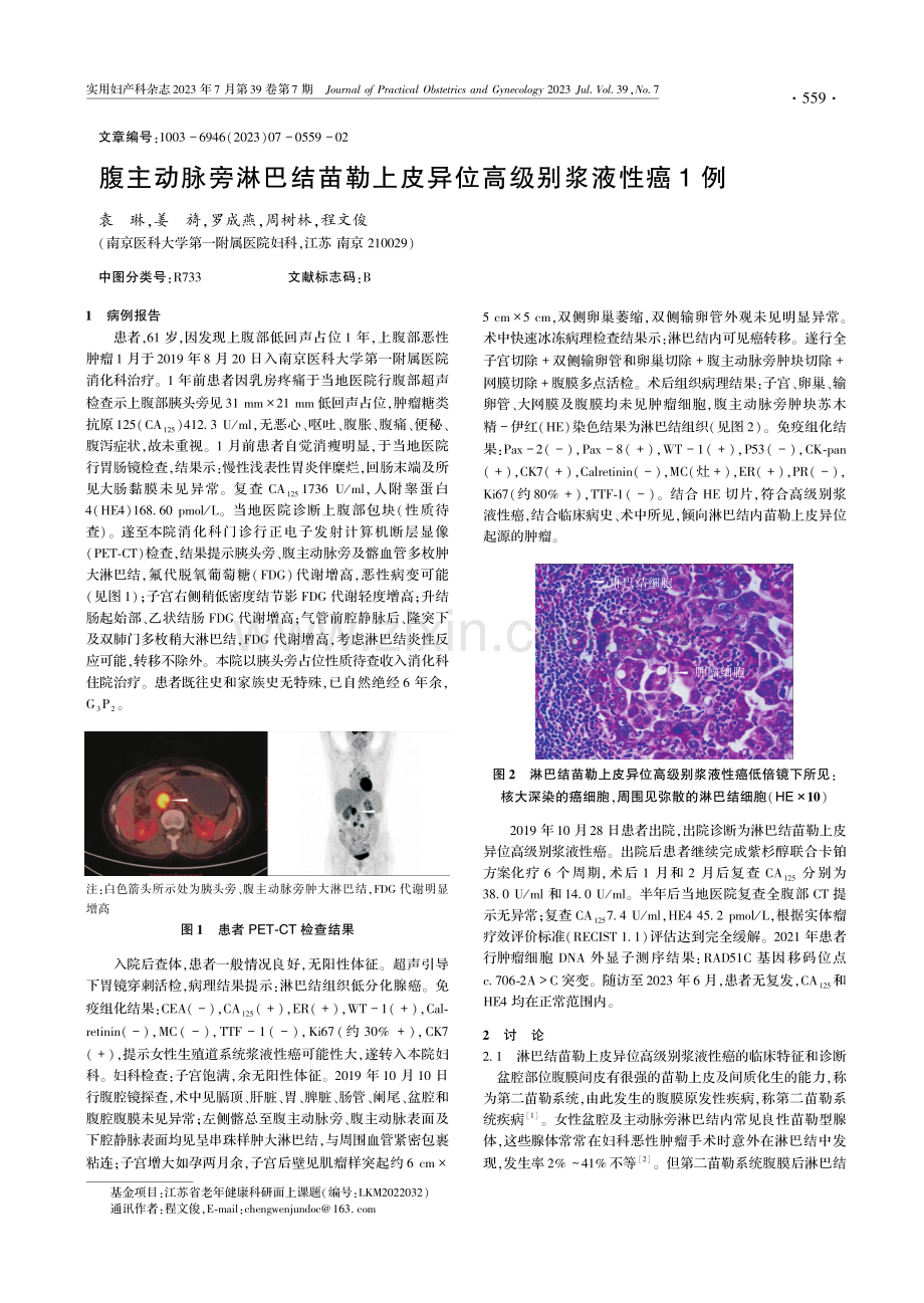 腹主动脉旁淋巴结苗勒上皮异位高级别浆液性癌1例.pdf_第1页