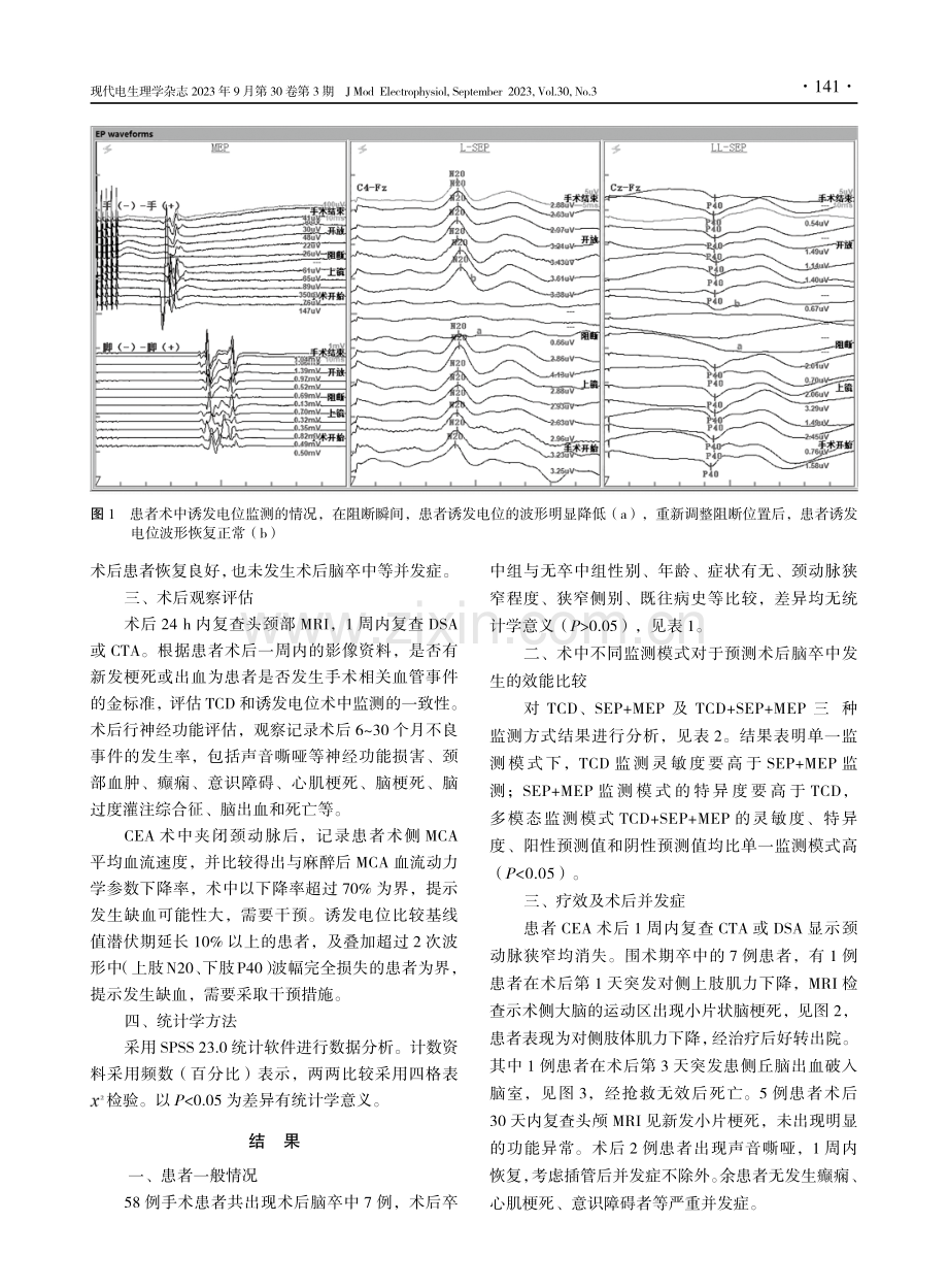 多模态监测在颈动脉内膜剥脱术中的应用.pdf_第3页