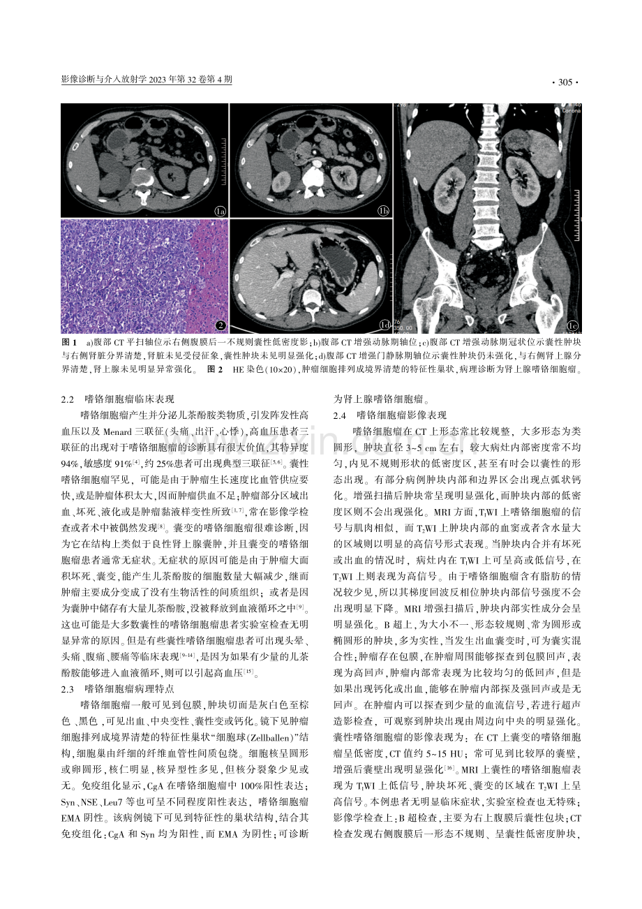 腹膜后完全囊变的嗜铬细胞瘤一例.pdf_第2页
