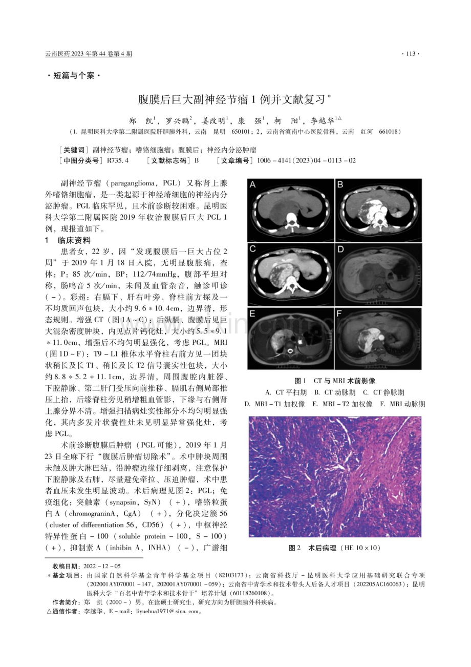 腹膜后巨大副神经节瘤1例并文献复习.pdf_第1页