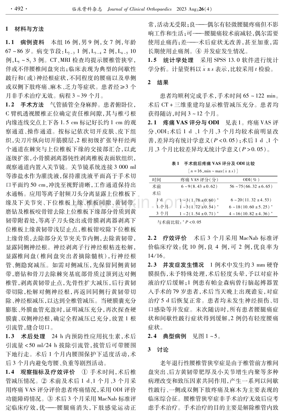 单侧双通道关节镜技术治疗老年退行性腰椎管狭窄症.pdf_第2页