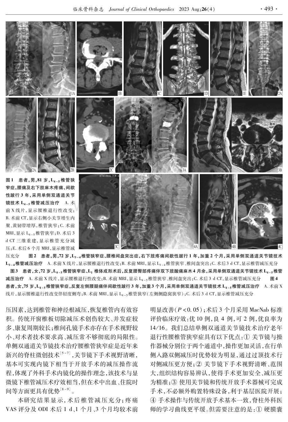 单侧双通道关节镜技术治疗老年退行性腰椎管狭窄症.pdf_第3页