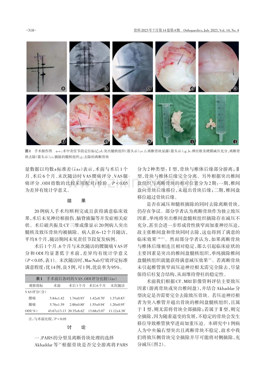 单侧双通道内镜技术治疗腰椎椎体后缘离断症的临床疗效.pdf_第3页