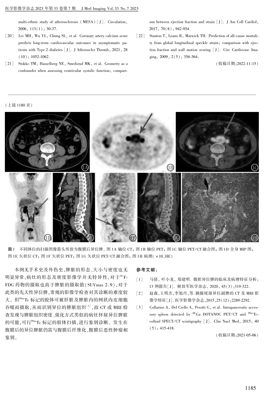 腹膜后异位脾18F-FDG PET_CT显像1例.pdf_第2页