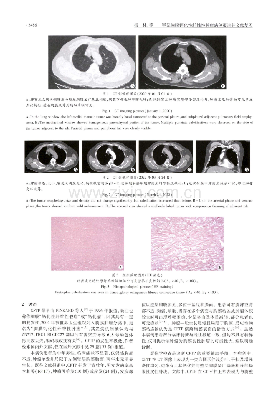 罕见胸膜钙化性纤维性肿瘤病例报道并文献复习.pdf_第2页