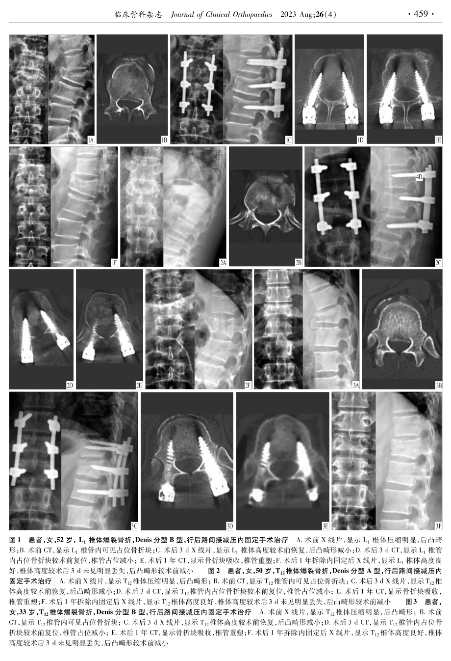 后路间接减压内固定治疗胸腰椎爆裂骨折.pdf_第3页