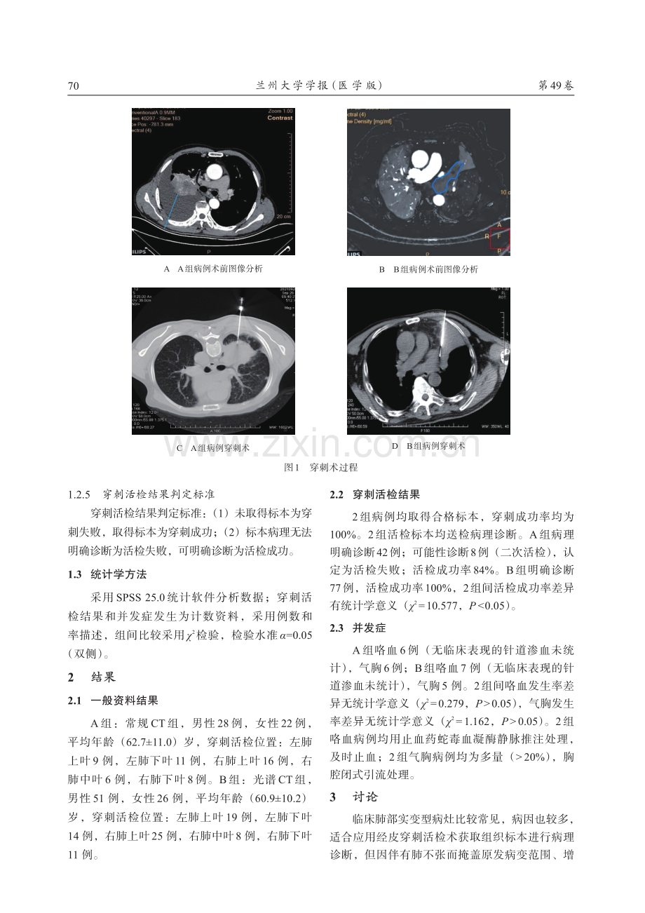 光谱CT碘密度图在肺部实变型病灶穿刺活检术中的应用.pdf_第3页