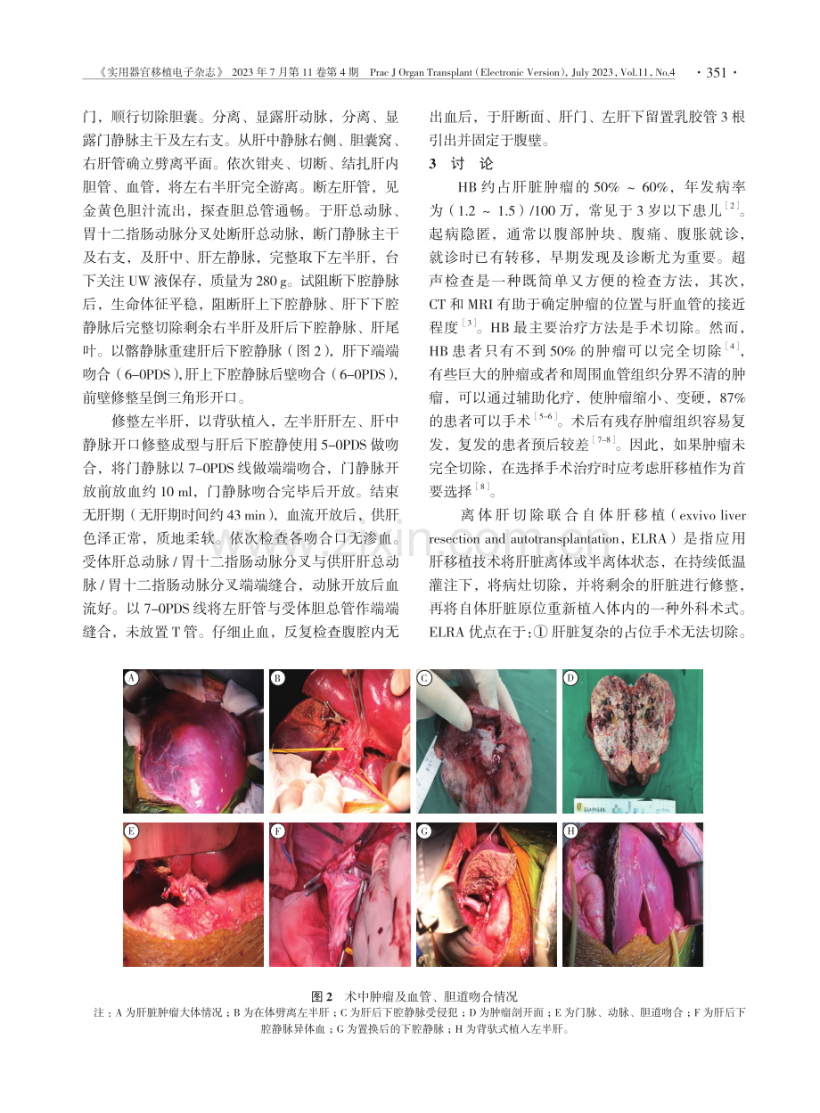 改良自体肝移植治疗儿童肝母细胞瘤1例并文献复习.pdf_第2页