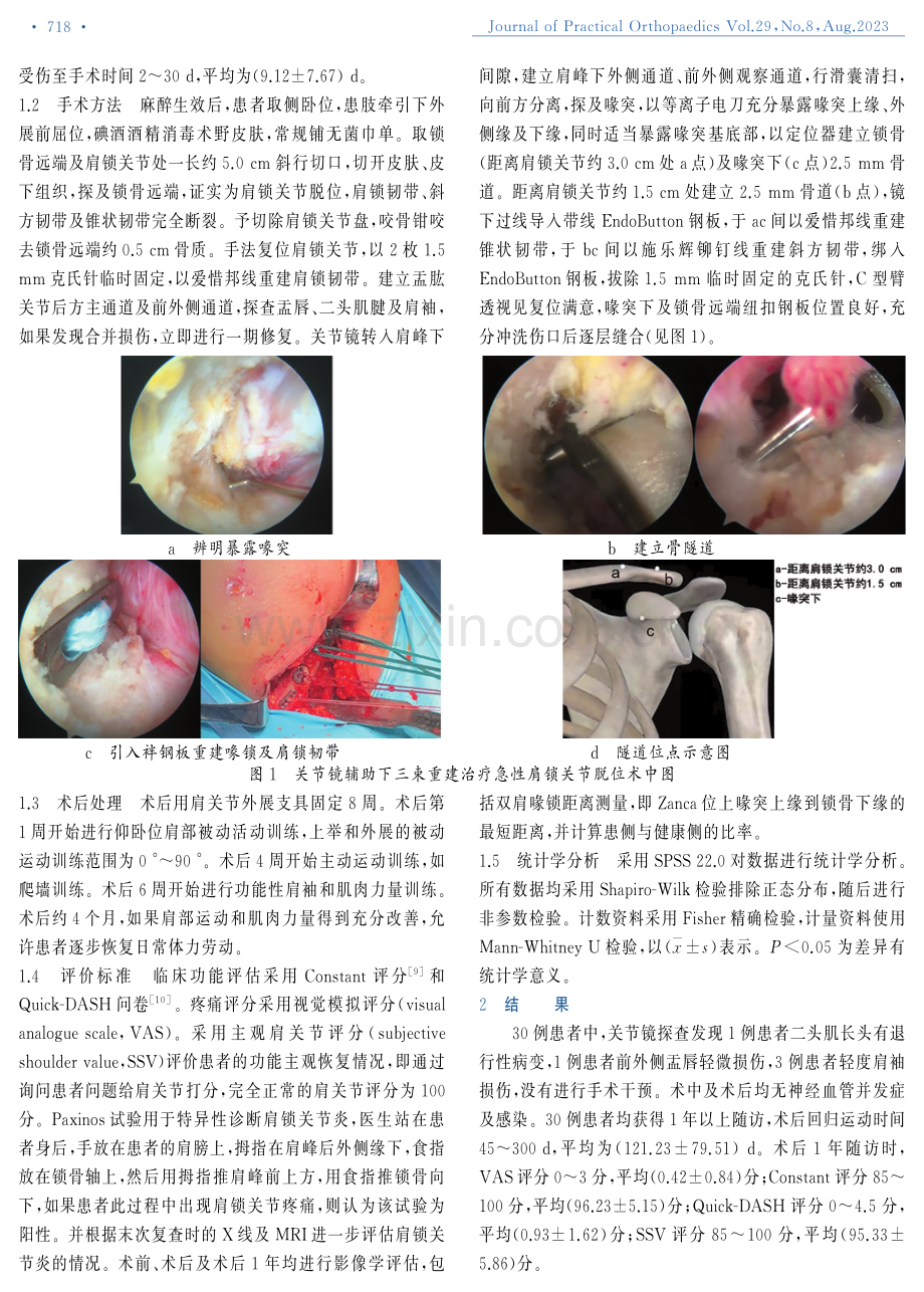 关节镜辅助下三束重建治疗急性肩锁关节脱位.pdf_第2页