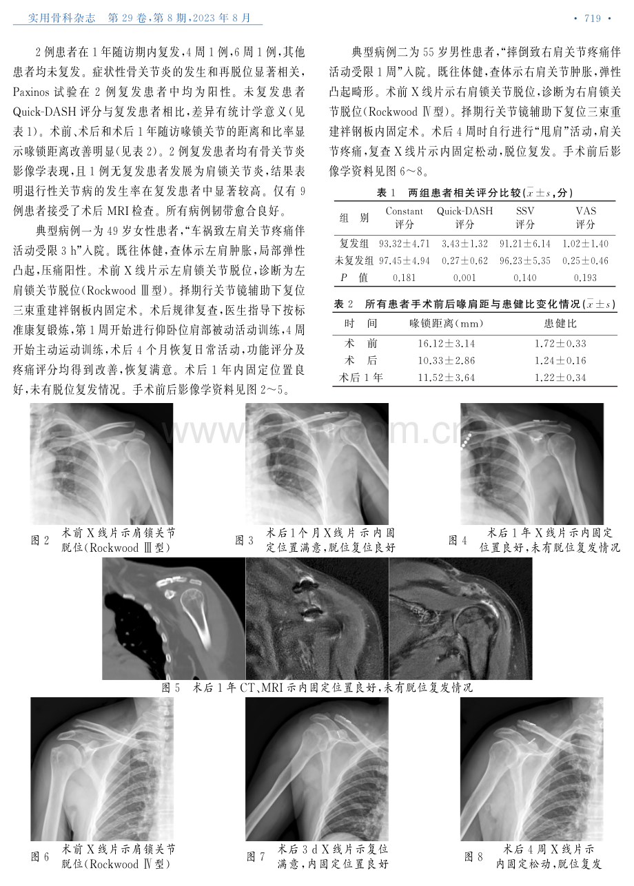 关节镜辅助下三束重建治疗急性肩锁关节脱位.pdf_第3页