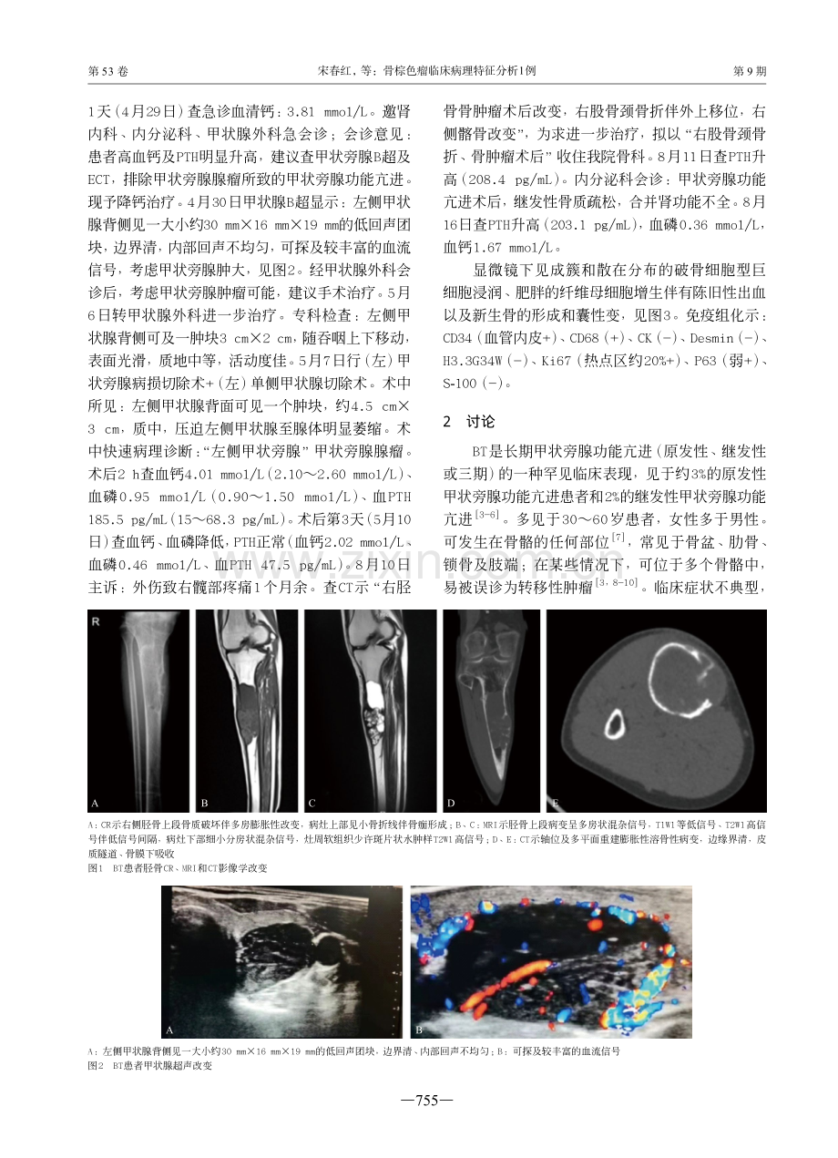 骨棕色瘤临床病理特征分析1例.pdf_第2页