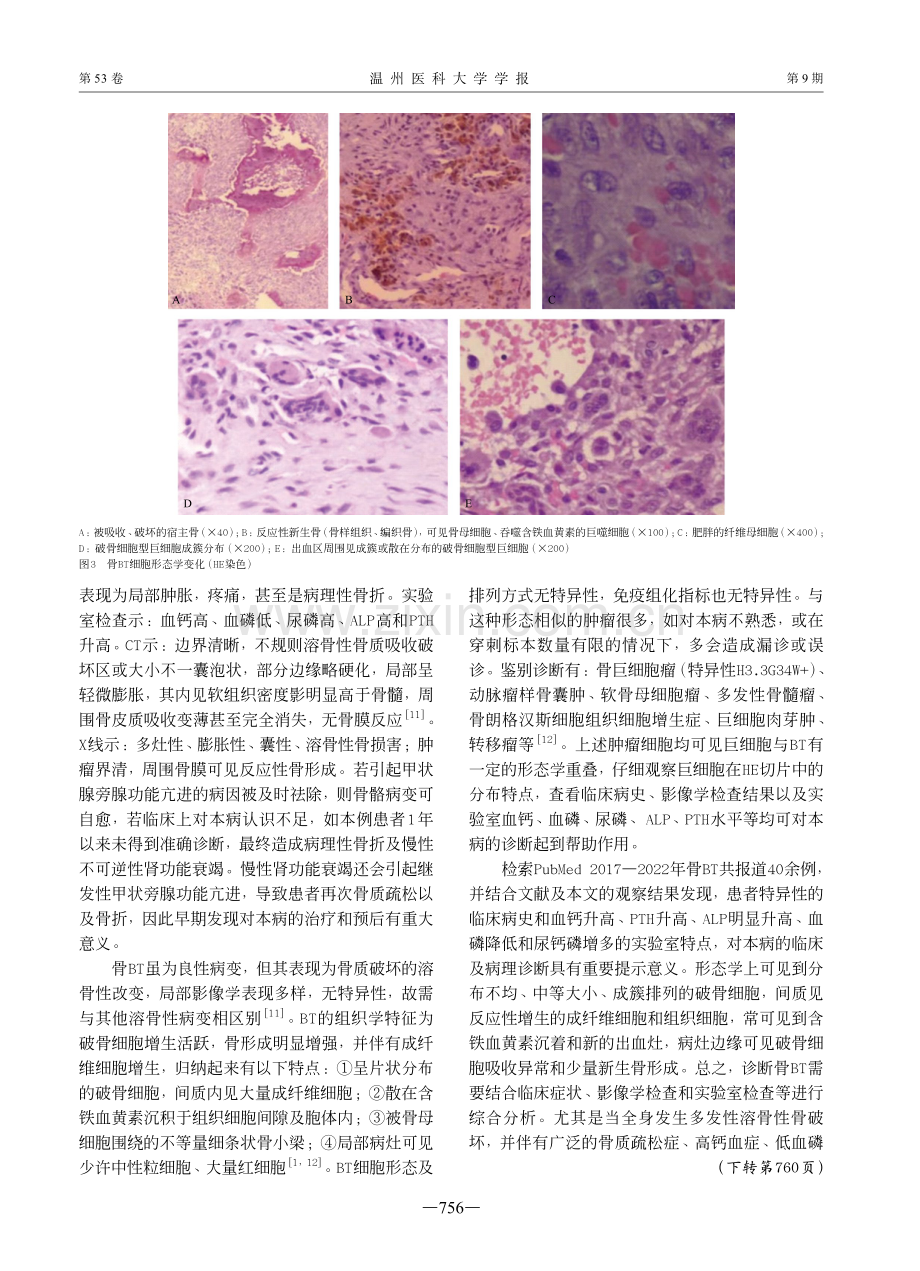 骨棕色瘤临床病理特征分析1例.pdf_第3页