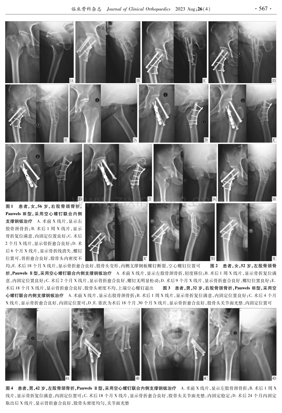 空心螺钉联合内侧支撑钢板治疗青壮年Pauwls Ⅱ、Ⅲ型股骨颈骨折.pdf_第3页