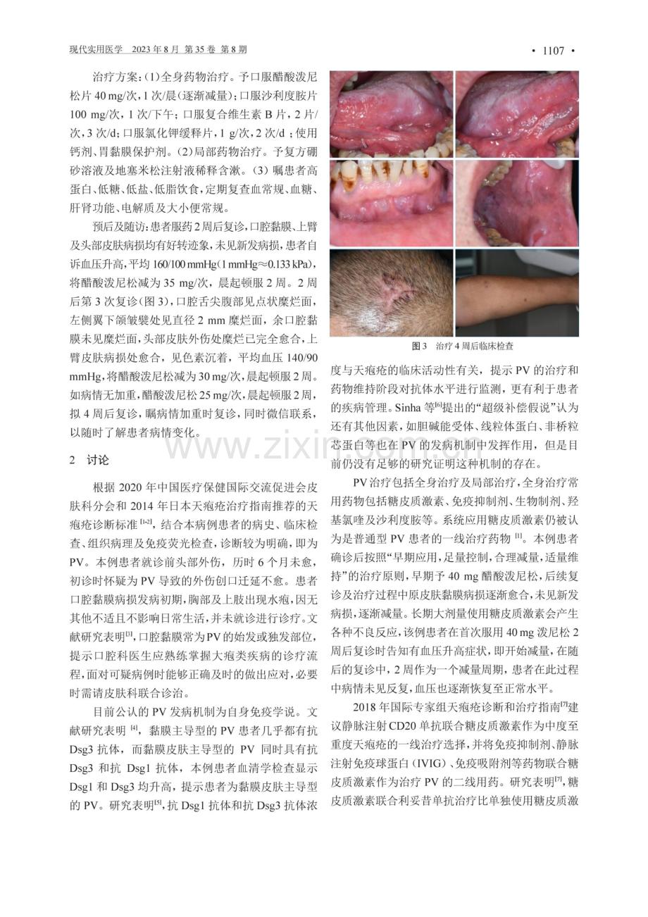 口腔黏膜合并皮肤寻常型天疱疮1例报告.pdf_第2页