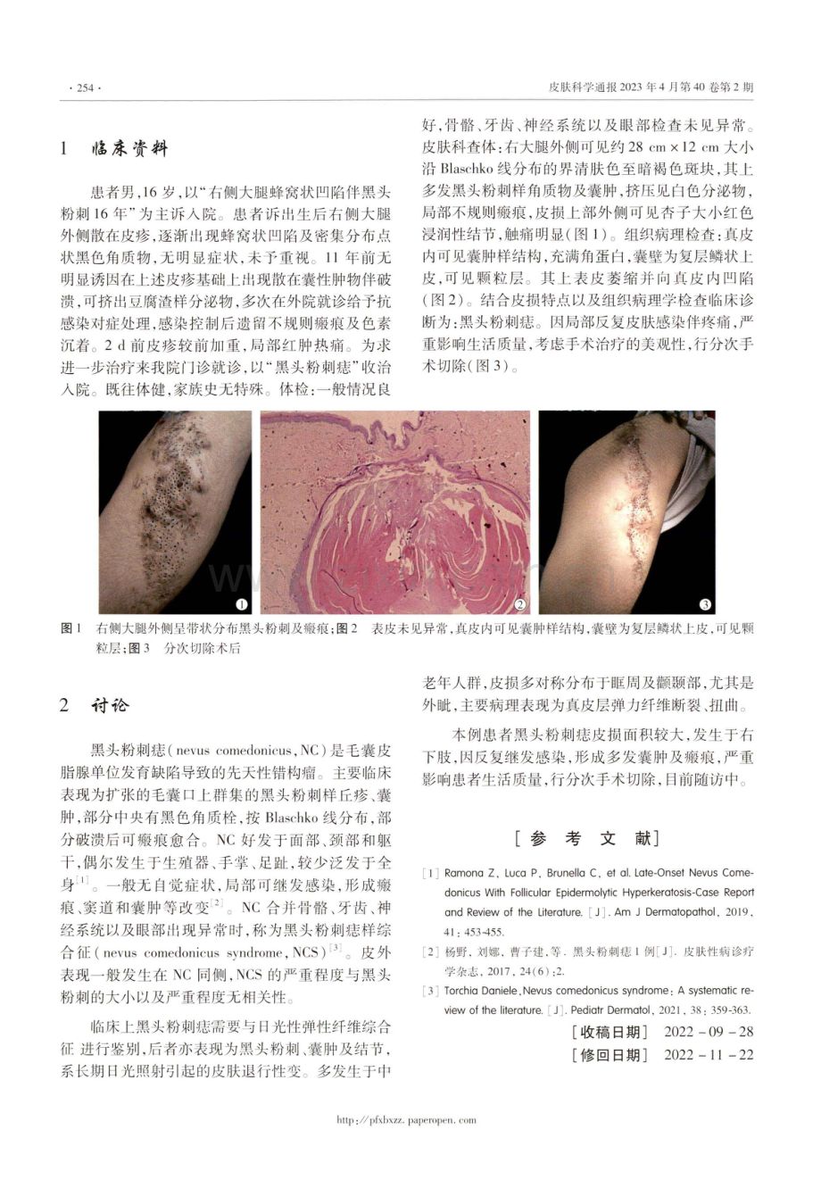 巨大黑头粉刺痣1例.pdf_第2页