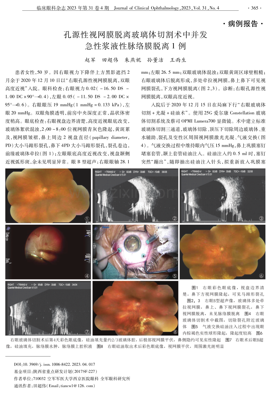 孔源性视网膜脱离玻璃体切割术中并发急性浆液性脉络膜脱离1例.pdf_第1页