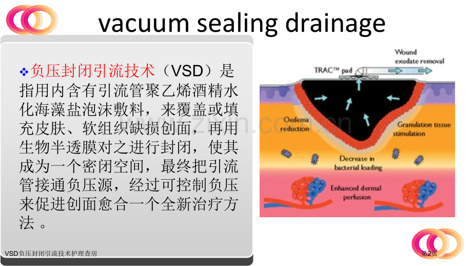 VSD负压封闭引流技术护理查房.pptx_第2页