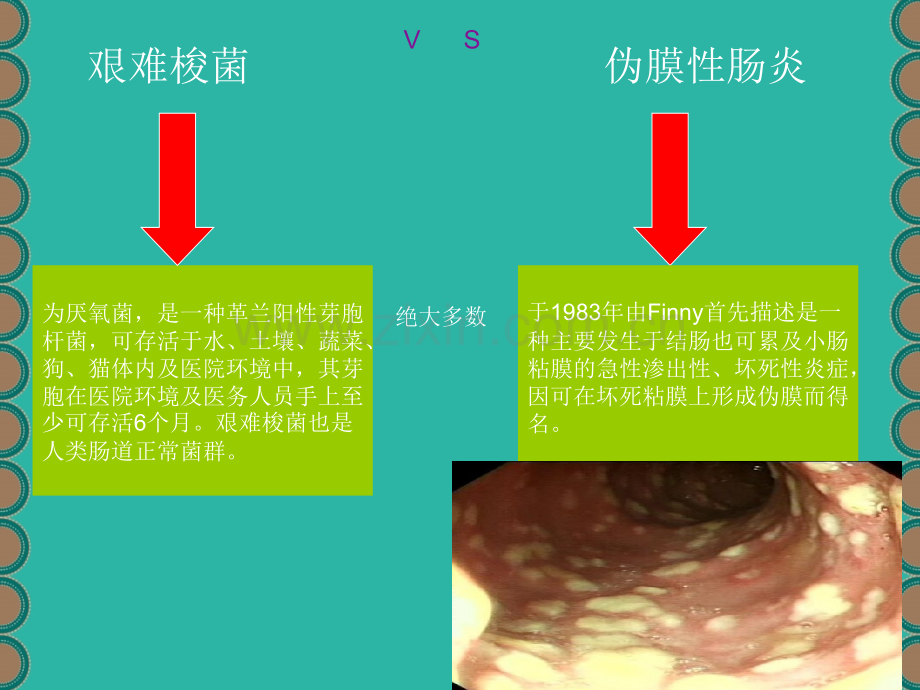 抗生素相关性艰难梭菌伪膜性肠炎PPT优质课件.ppt_第2页