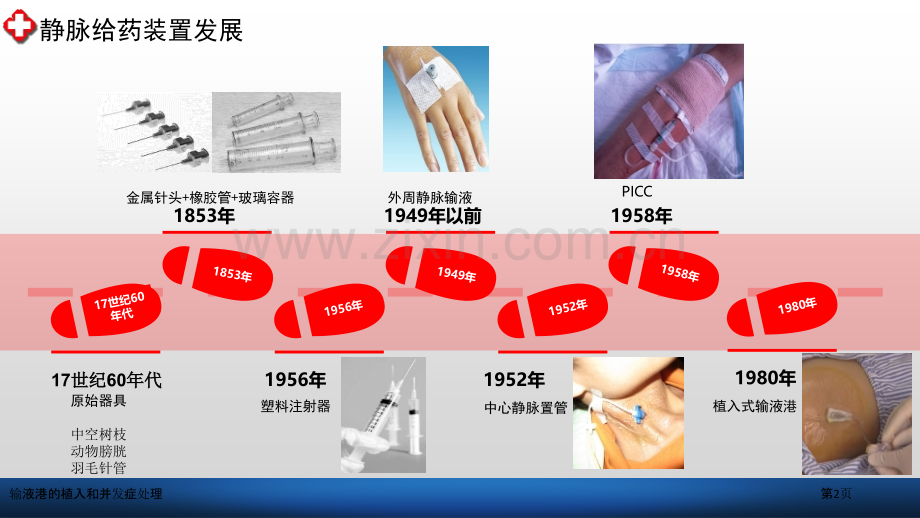 输液港的植入和并发症处理.pptx_第2页