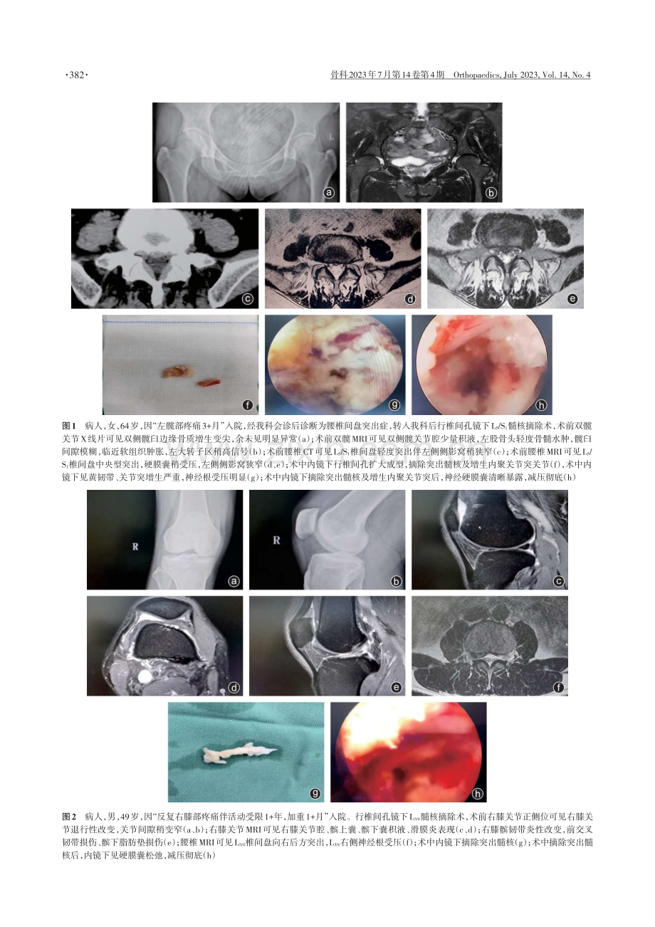 两例非典型腰椎间盘突出症误诊误治的病案报道.pdf_第2页