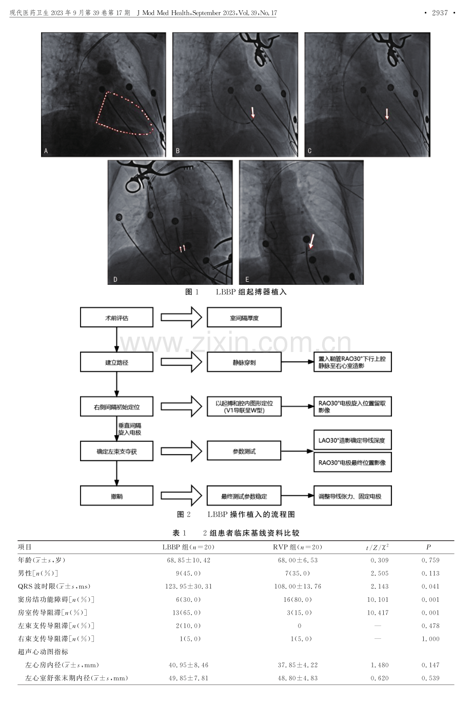 利用造影图像指导法指导左束支起搏的研究.pdf_第3页