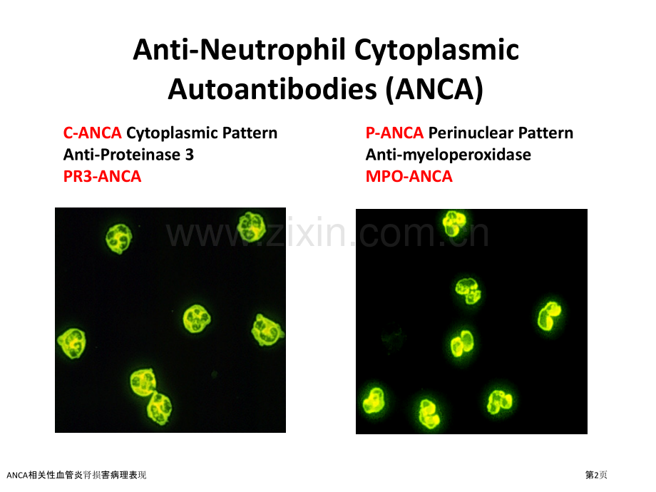 ANCA相关性血管炎肾损害病理表现.pptx_第2页