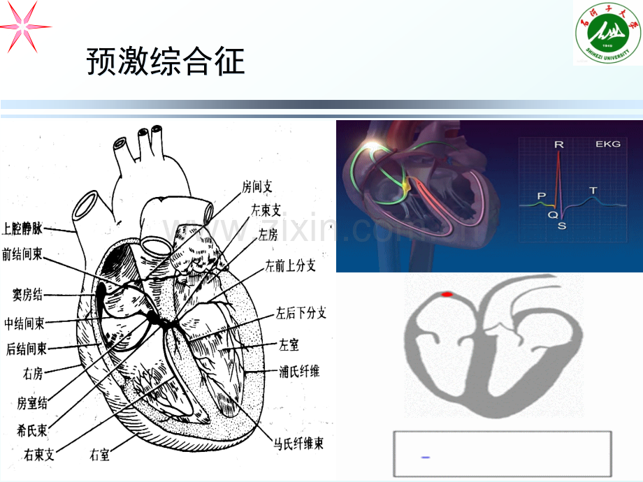 预激综合征PPT课件.ppt_第2页