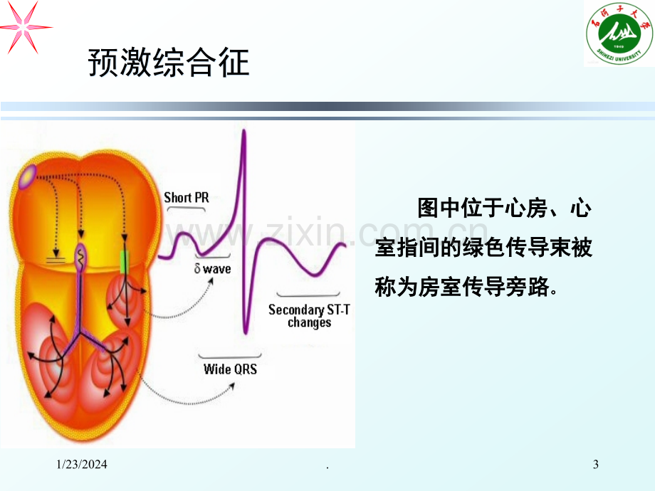 预激综合征PPT课件.ppt_第3页