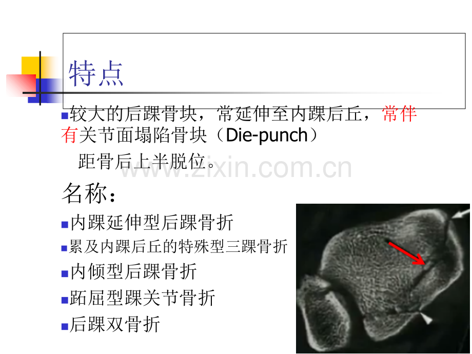 后pilon骨折足踝外科PPT培训课件.ppt_第3页