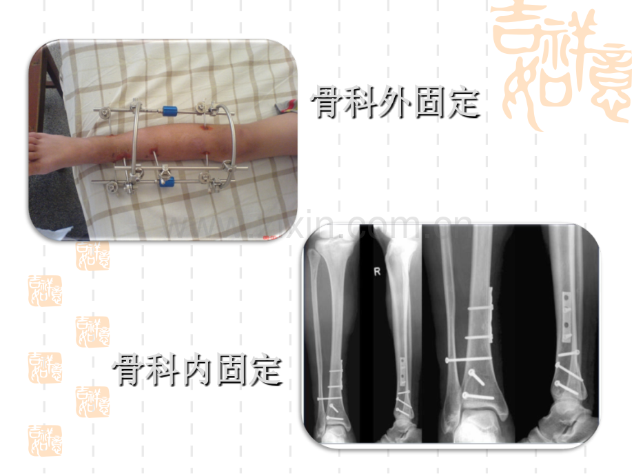 骨科手术后功能锻炼指导-医学课件.ppt_第3页