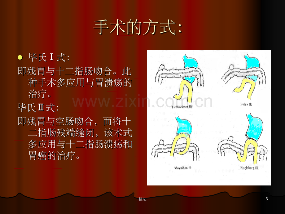 胃大部切除术后的护理ppt课件.ppt_第3页