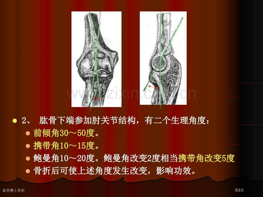 肱骨髁上骨折专家讲座.pptx_第3页