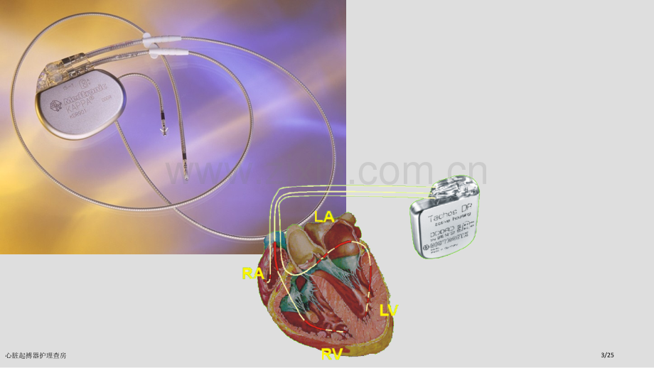 心脏起搏器护理查房.pptx_第3页