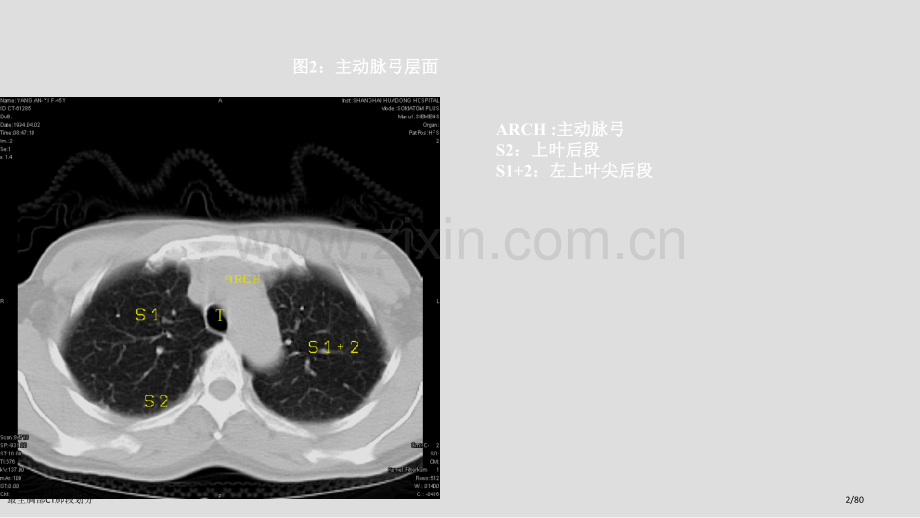 最全胸部CT肺段划分.pptx_第2页